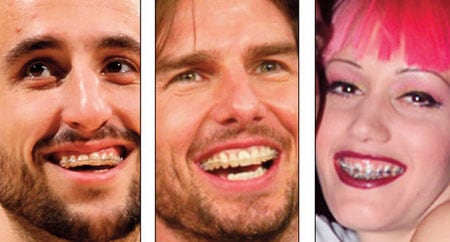 Celebrities with braces