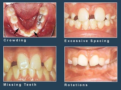 Common dental issues including spacing, crowding, missing teeth, and rotations.